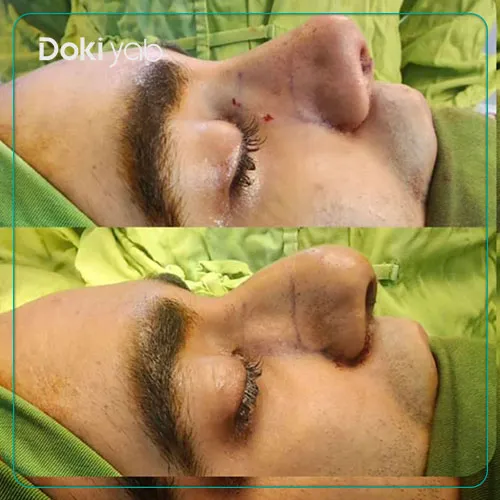 جراحی بینی توسط دکتر سعید مرزبان جراح پلاستیک در شیراز