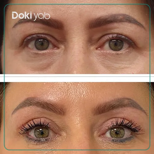 بلفاروپلاستی توسط دکتر سید طارخ فیصل حسین زاده جراح پلاستیک شیراز