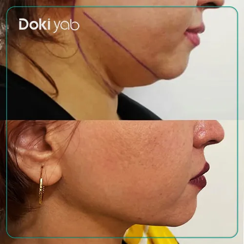 جراحی غبغب توسط دکتر سید طارخ فیصل حسین زاده جراح پلاستیک شیراز