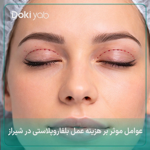 عوامل موثر بر هزینه عمل بلفاروپلاستی در شیراز