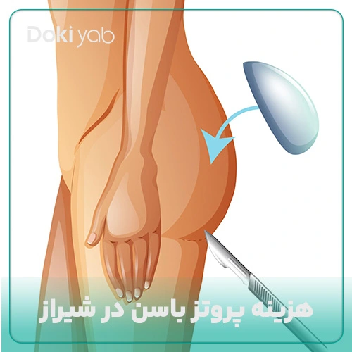 بررسی قیمت پروتز باسنهای نمونه در شیراز در دکی یاب