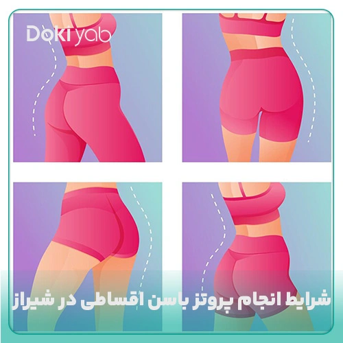 شرایط انجام پروتز باسن اقساطی در شیراز با دکی یاب