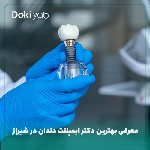 معرفی بهترین دکتر ایمپلنت دندان در شیراز با بررسی‌های تخصصی دکی یاب