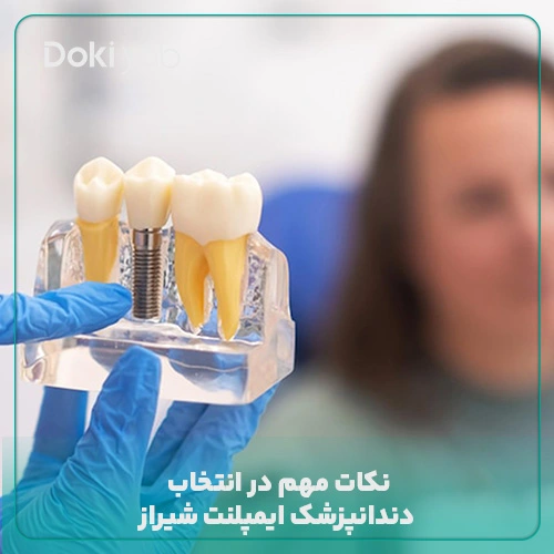 نکات مهم در انتخاب دندانپزشک ایمپلنت شیراز