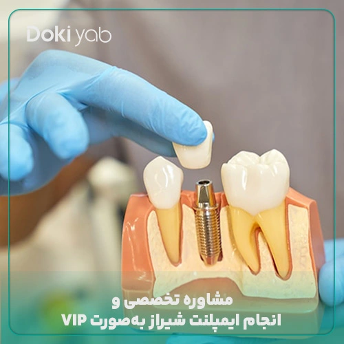 مشاوره تخصصی و انجام ایمپلنت شیراز به‌صورت VIP با دکی یاب