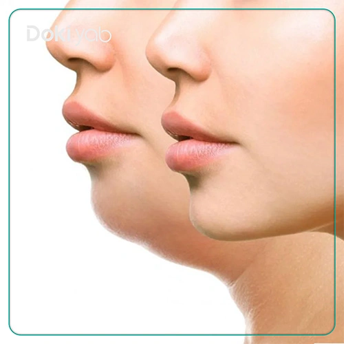 عمل ساکشن غبغب در شیراز 