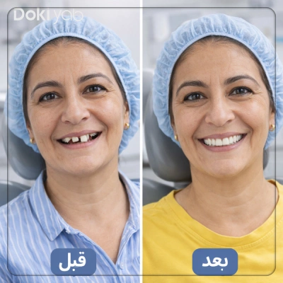 عکس قبل و بعد از ایمپلنت دندان در شیراز برای مراجعه کننده خانم