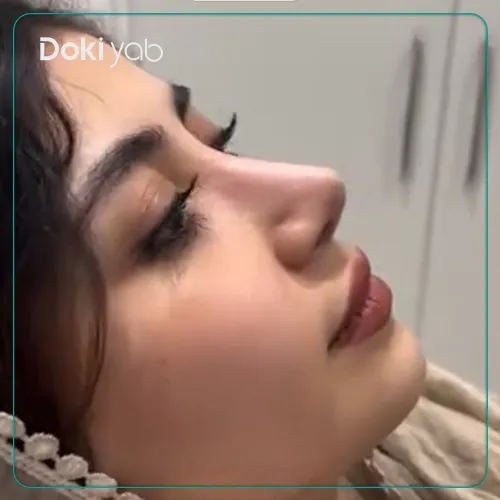 جراحی بینی توسط آرش شرفیان در تهران