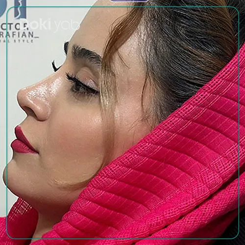 نمونه کار جراحی بینی آرش شرفیان در تهران