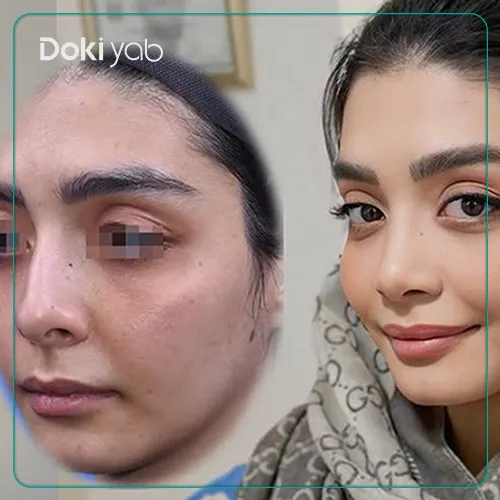 جراحی بینی با آرش شرفیان در تهران