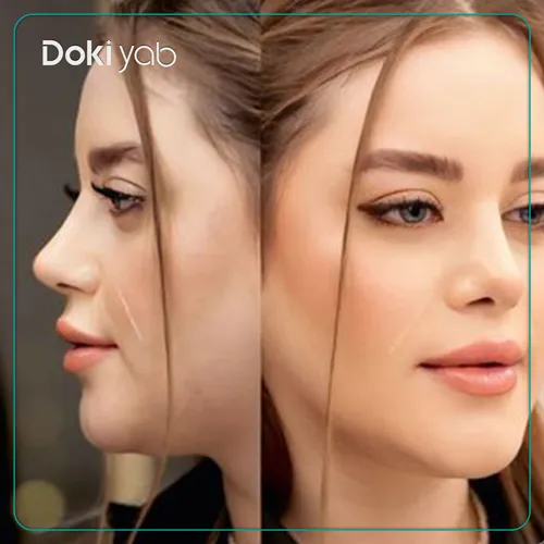 عکس قبل و بعد عمل بینی نیمه فانتزی دخترانه با دکتر علیرضا محبی در تهران