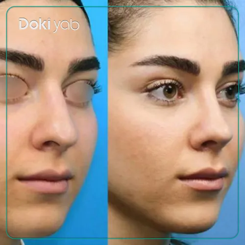 نمونه کار عمل بینی طبیعی در مطب دکتر علیرضا محبی، جراح بینی در تهران