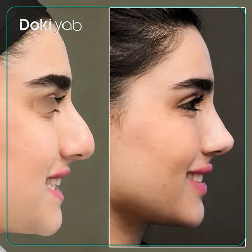 عکس قبل و بعد عمل زیبایی بینی استخوانی انجام‌شده توسط دکتر علیرضا محبی، جراح بینی تهران