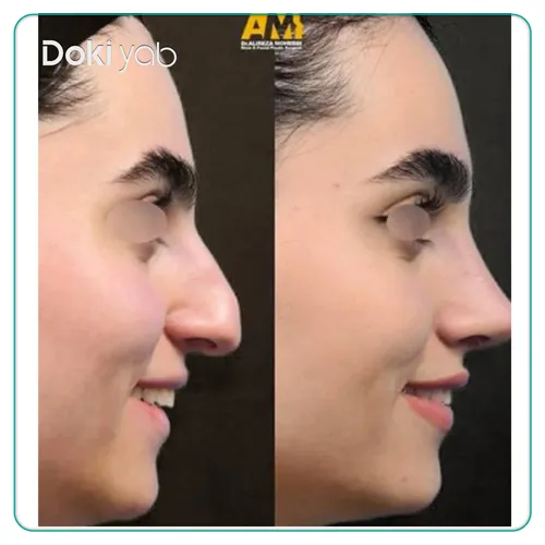 نمونه عمل بینی فانتزی ملایم توسط دکتر علیرضا محبی، یکی از جراحان مطرح بینی در تهران