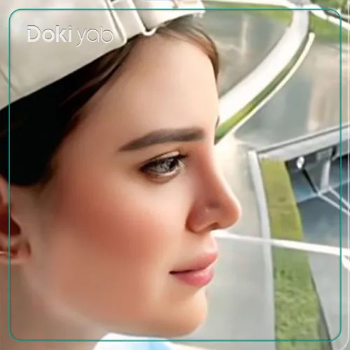 تصویر نتیجه رینوپلاستی برای اصلاح قوز و انحراف بینی با جراحی دکتر علیرضا محبی در تهران