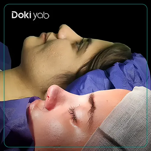 نمونه عمل جراحی بینی دکتر ساناز کیومرثی تهران