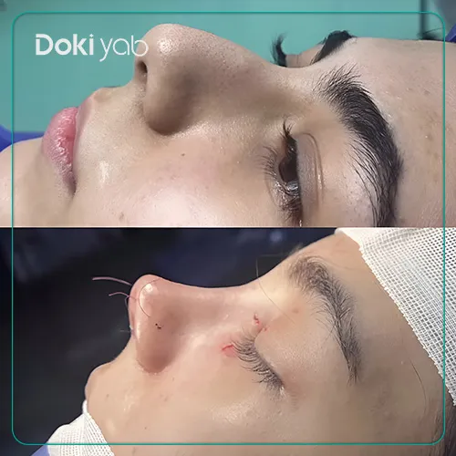 جراحی بینی توسط دکتر ساناز کیومرثی در تهران