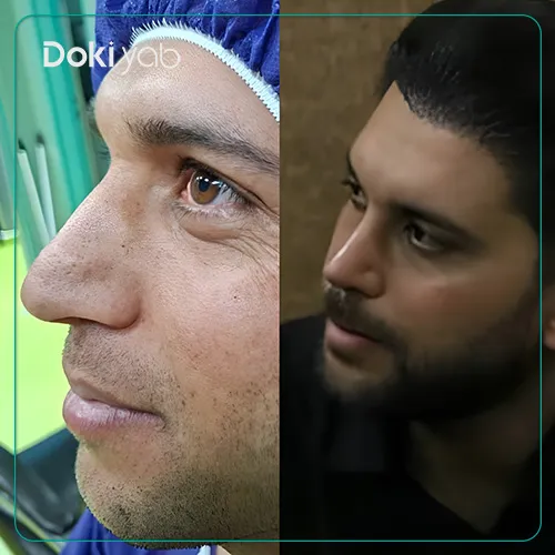 عکس جراحی بینی توسط دکتر ساناز کیومرثی در تهران