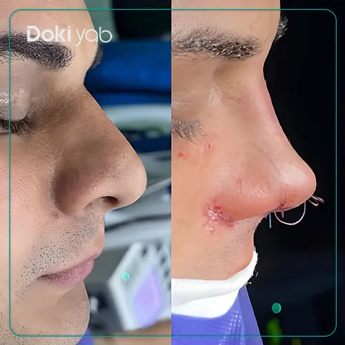 نمونه جراحی بینی با دکتر ساناز کیومرثی متخصص جراحی بینی تهران