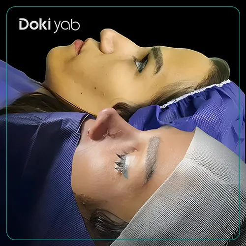 نمونه کار جراحی بینی دکتر ساناز کیومرثی در تهران