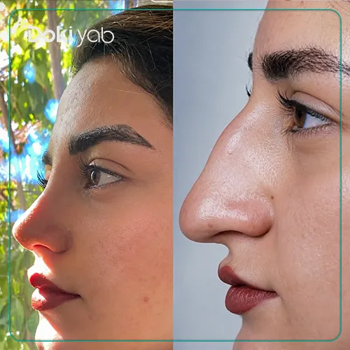 قبل و بعد عمل بینی دکتر پور برفه ای جراح بینی شیراز