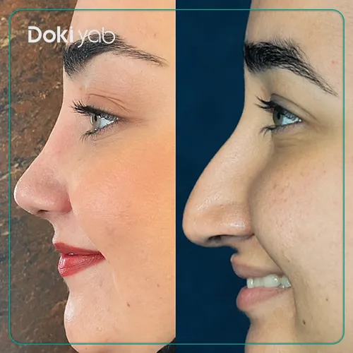جراحی زیبایی بینی با دکتر دکتر پوربرفه ای جراح بینی