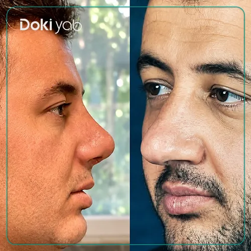 نمونه عمل بینی مردانه با دکتر پوربرفه ای جراح بینی