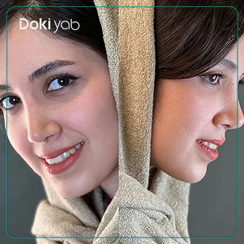 نمونه جراحی بینی با دکتر اسدالله مهدوی در تهران