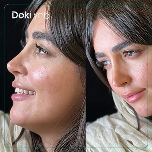 عکس نمونه کار جراحی بینی با دکتر اسدالله مهدوی در تهران