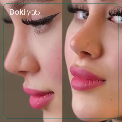 جراحی بینی توسط دکتر اسدالله مهدوی در تهران