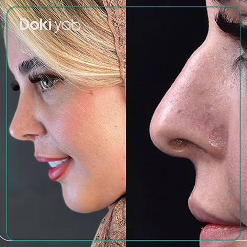 عکس جراحی بینی توسط دکتر مهدوی در تهران