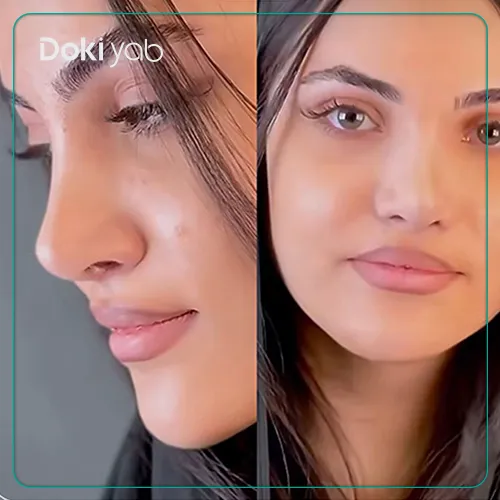 نمونه جراحی بینی با دکتر اسدالله مهدوی متخصص جراحی بینی تهران