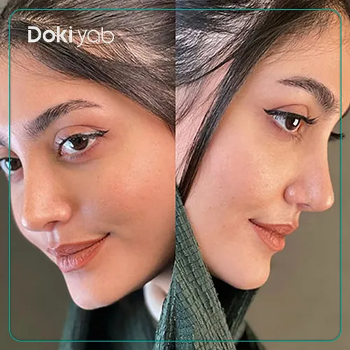 نمونه کار جراحی بینی دکتر اسدالله مهدوی در تهران
