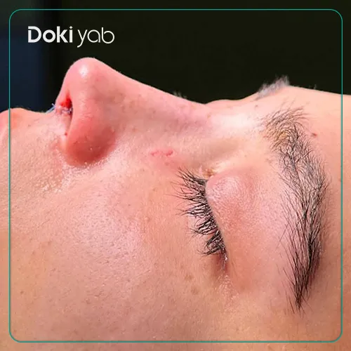 نمونه جراحی بینی با دکتر حمیدرضا نوری متخصص جراحی بینی تهران