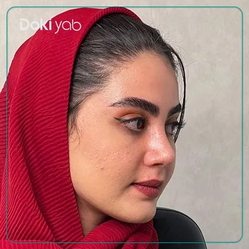 عکس نمونه کار جراحی بینی با دکتر رویا لطفی یگانه در تهران