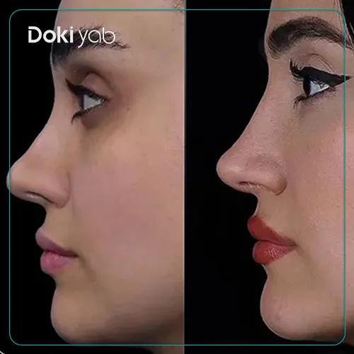 عکس نمونه کار جراحی بینی با دکتر شاهین باستانی نژاد در تهران