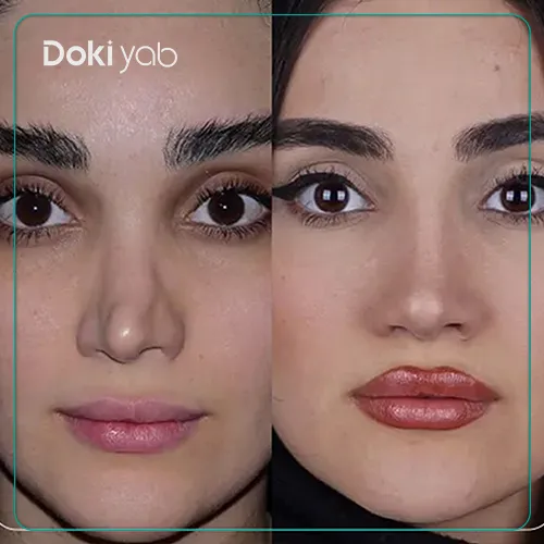نمونه جراحی بینی با دکتر شاهین باستانی نژاد متخصص جراحی بینی تهران