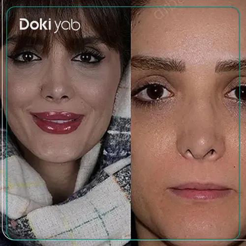 تصویر عمل جراحی بینی با دکتر شاهین باستانی نژاد در تهران