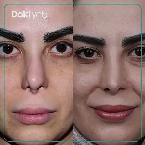 تصویر جراحی بینی توسط دکتر شاهین باستانی نژاد در تهران