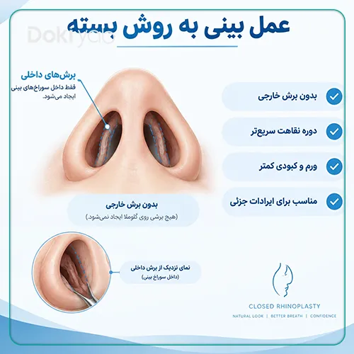 نحوه عمل بینی به روش بسته