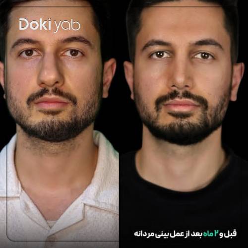 نمونه جراحی بینی طبیعی مردانه توسط دکتر مریم بحری