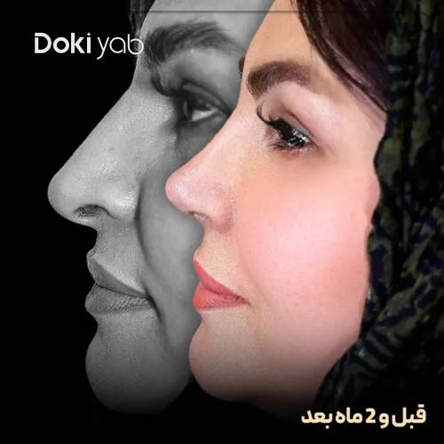 نمونه نتیجه جراحی بینی طبیعی زنانه توسط دکتر مریم بحری