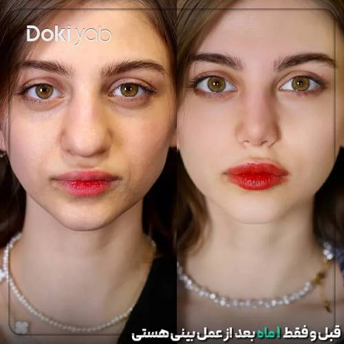 نمونه نتیجه جراحی بینی گوشتی توسط دکتر مریم بحری
