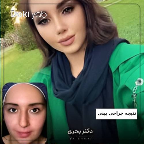 نمونه عمل بینی طبیعی دخترانه توسط دکتر مریم بحری