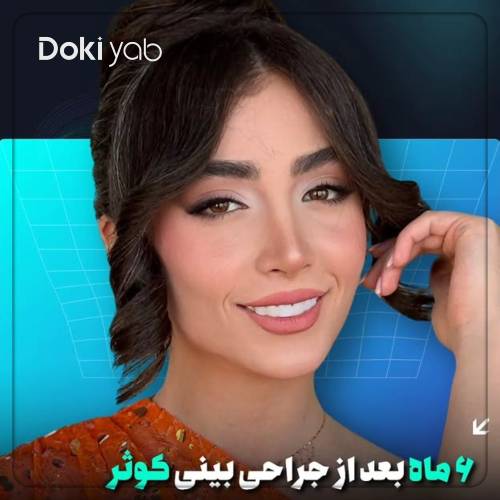 جراحی بینی استخوانی طبیعی توسط دکتر مریم بحری