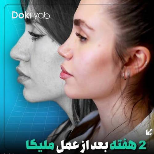 نمونه جراحی بینی استخوانی توسط دکتر مریم بحری