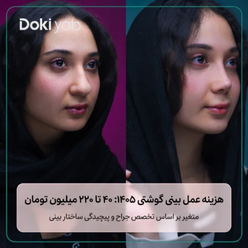 حدود هزینه عمل بینی پهن و گوشتی؛ نمونه جراحی بینی در دکی یاب