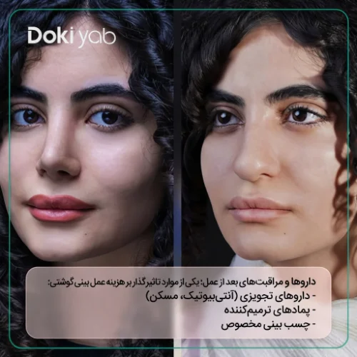 نمونه عمل بینی در دکی یاب؛ بررسی تاثیر مراقبت‌های بعد از جراحی بر هزینه عمل دماغ گوشتی
