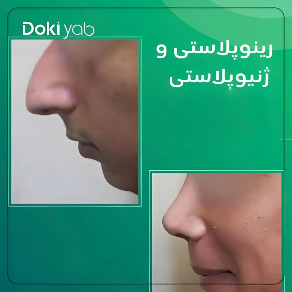 جراحی بینی استخوانی و قوزدار توسط دکتر محمودرضا اصحاب یمین