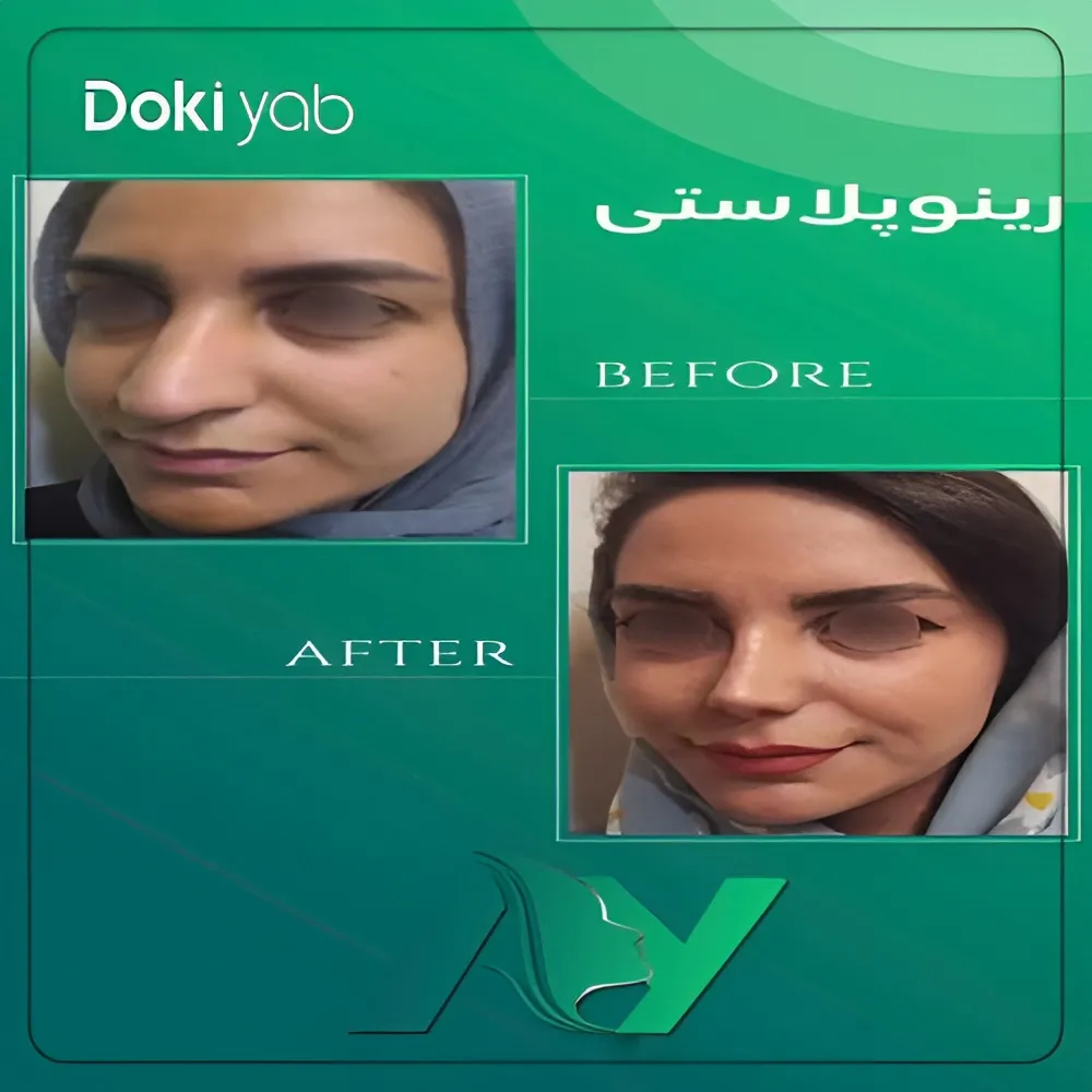جراحی بینی استخوانی و قوزدار توسط دکتر محمودرضا اصحاب یمین